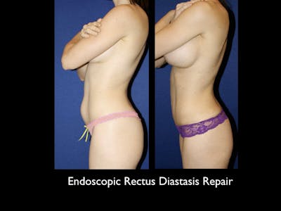 Tummy Tuck Before & After Gallery - Patient 79205153 - Image 1