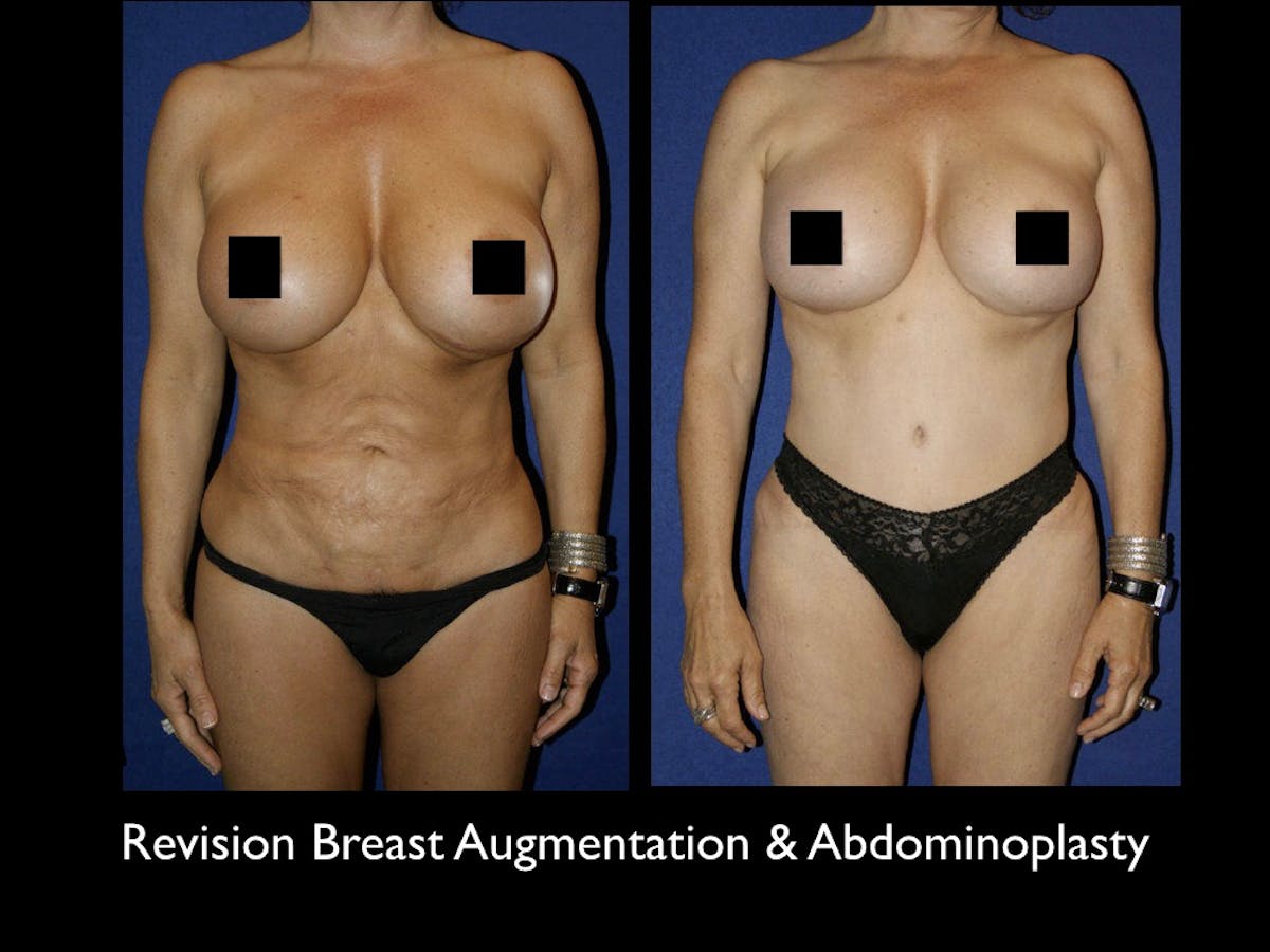 Tummy Tuck Before & After Gallery - Patient 79205154 - Image 1