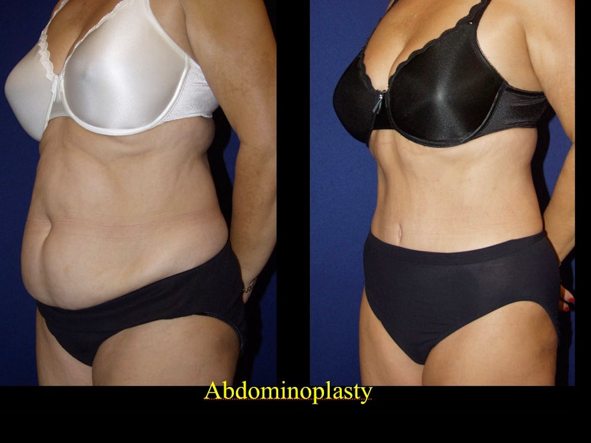 Tummy Tuck Before & After Gallery - Patient 79205145 - Image 2