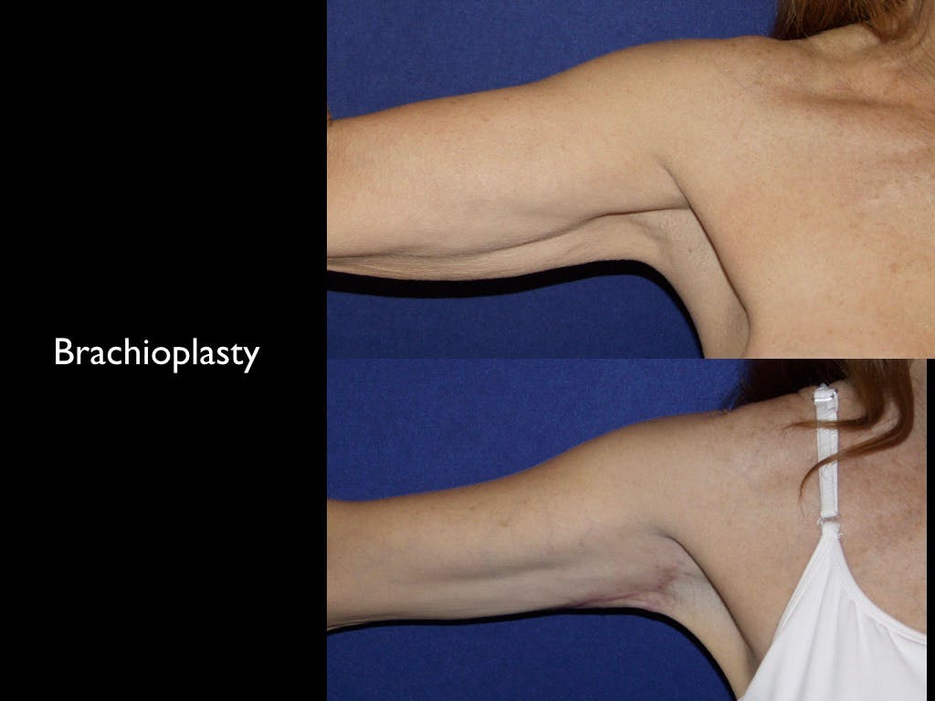 Arm Lift Before & After Gallery - Patient 68373595 - Image 1