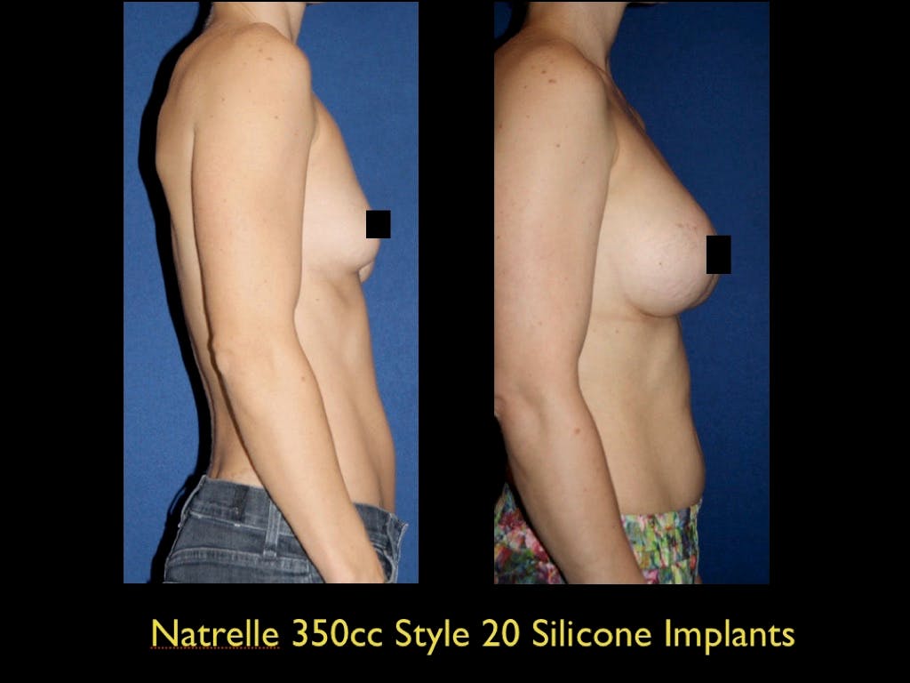 Breast Augmentation