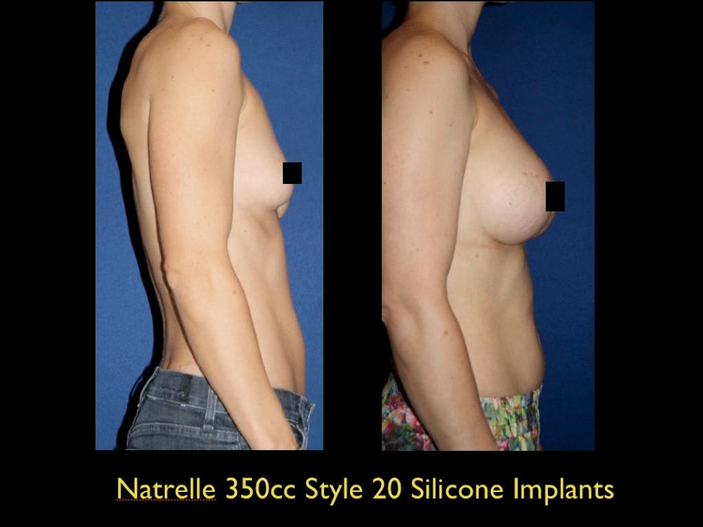 Breast Augmentation Before & After Gallery - Patient 79205607 - Image 1