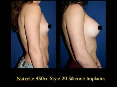 Breast Augmentation Before & After Gallery - Patient 79205608 - Image 1