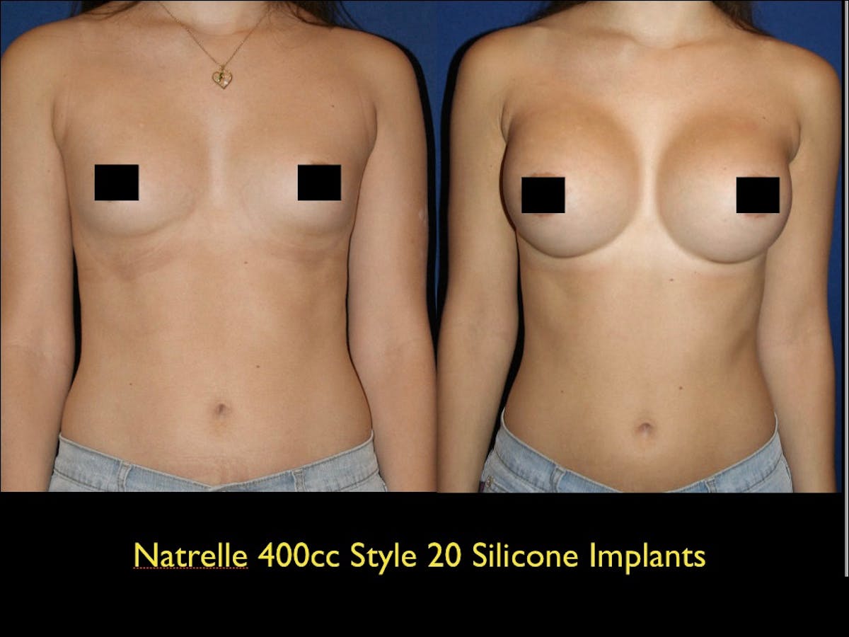 Breast Augmentation Before & After Gallery - Patient 79205609 - Image 1