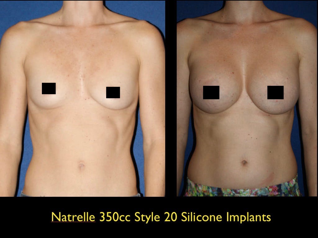 Breast Augmentation Before & After Gallery - Patient 79205610 - Image 1