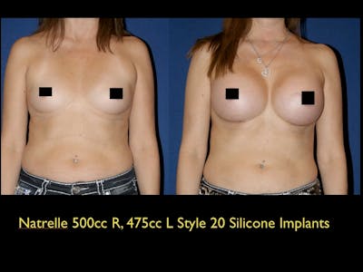 Breast Augmentation Before & After Gallery - Patient 79205611 - Image 1