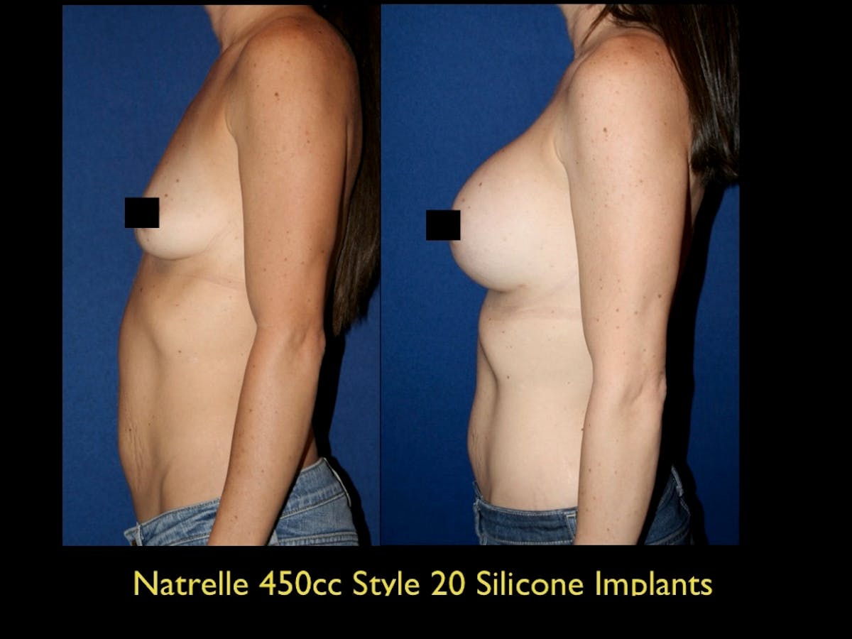 Breast Augmentation Before & After Gallery - Patient 79205612 - Image 1