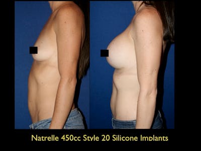 Breast Augmentation Before & After Gallery - Patient 79205612 - Image 1