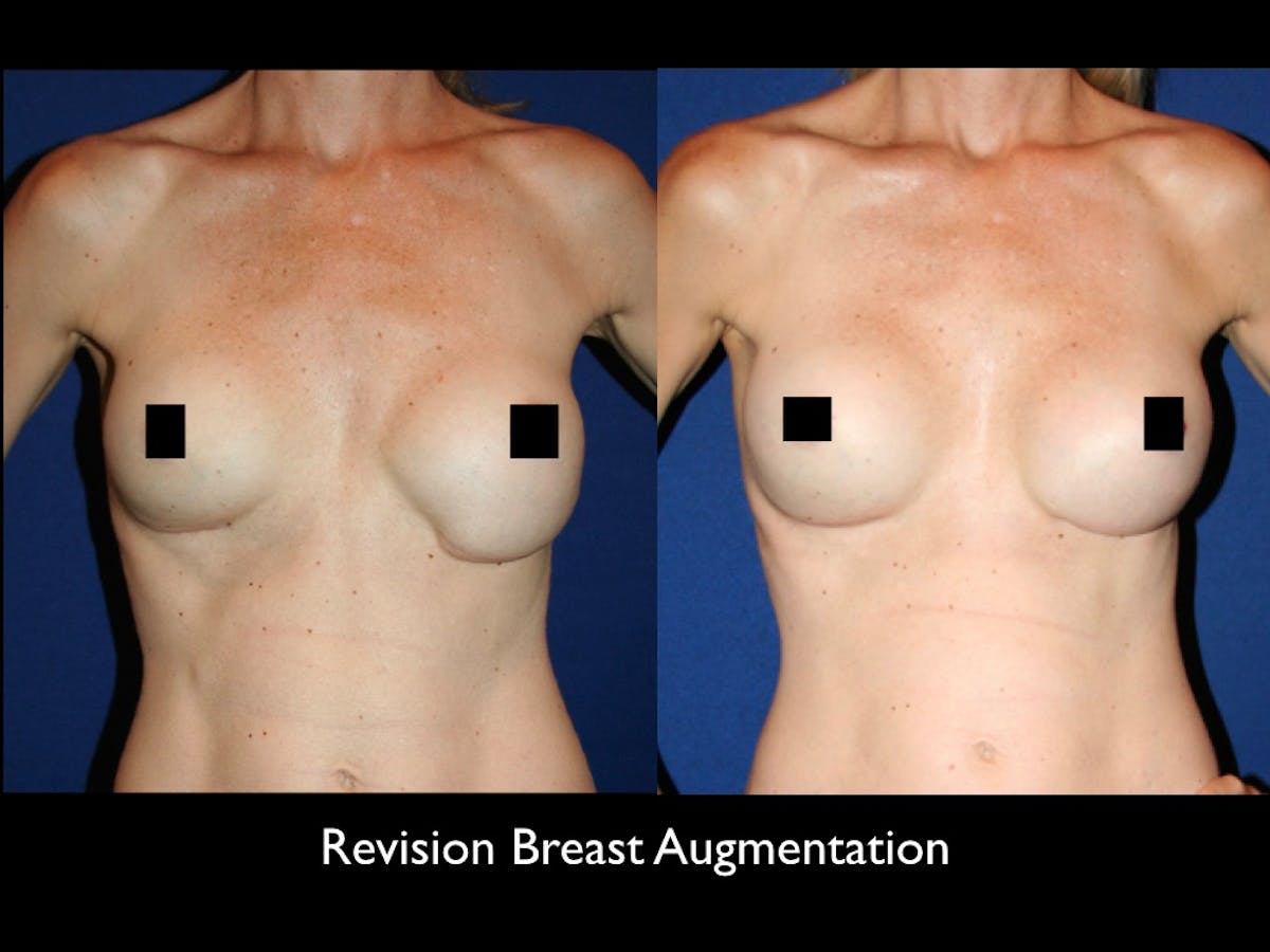 Breast Revision Before & After Gallery - Patient 68373634 - Image 1