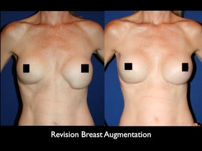 Breast Revision Before & After Gallery - Patient 68373634 - Image 1