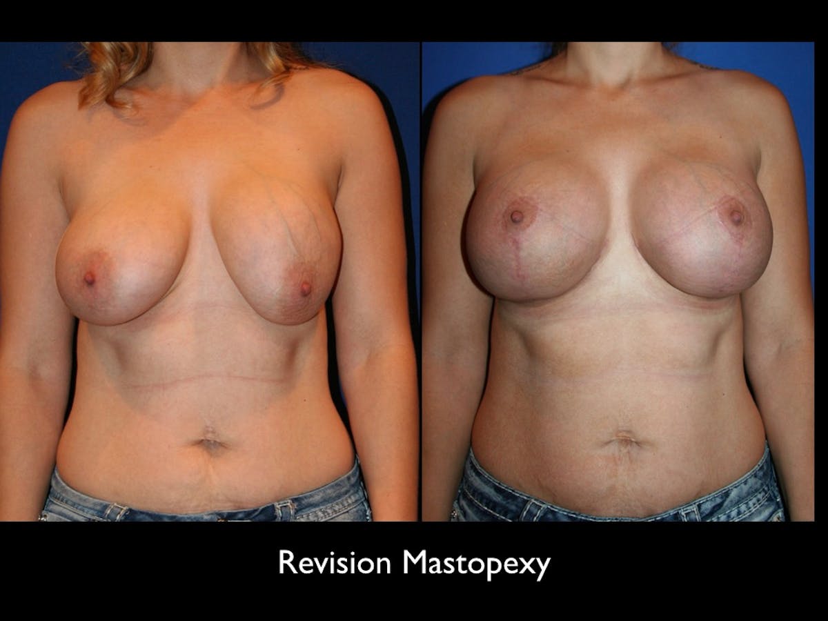 Breast Revision Before & After Gallery - Patient 68373635 - Image 1