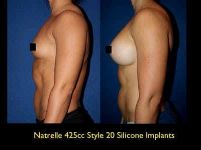 Breast Augmentation Before & After Gallery - Patient 79205616 - Image 1