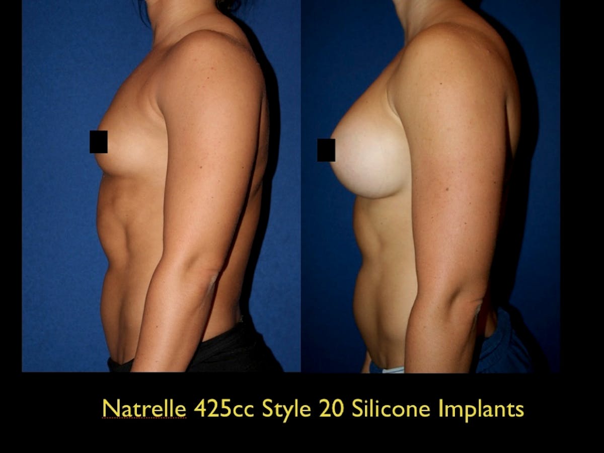 Breast Augmentation Before & After Gallery - Patient 79205616 - Image 1