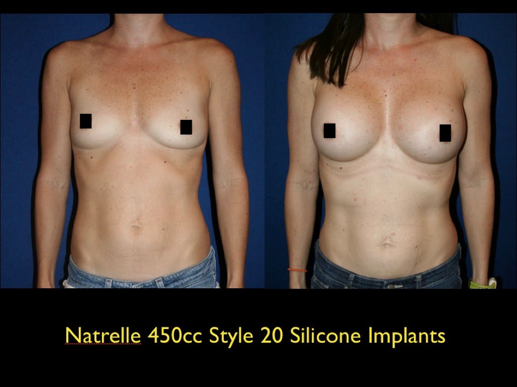 Breast Augmentation Before & After Gallery - Patient 79205618 - Image 1