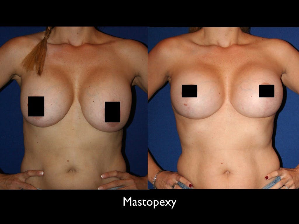 Breast Lift Before & After Gallery - Patient 79205798 - Image 1