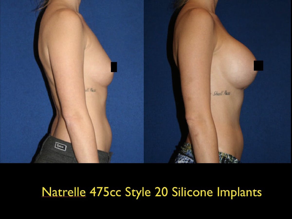 Breast Augmentation Before & After Gallery - Patient 79205622 - Image 1