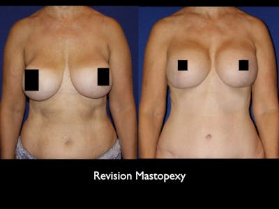 Breast Lift Before & After Gallery - Patient 79205800 - Image 1
