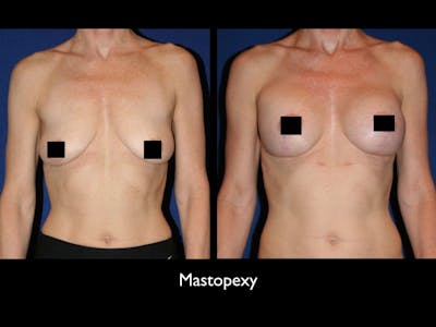 Breast Lift Before & After Gallery - Patient 79205801 - Image 1