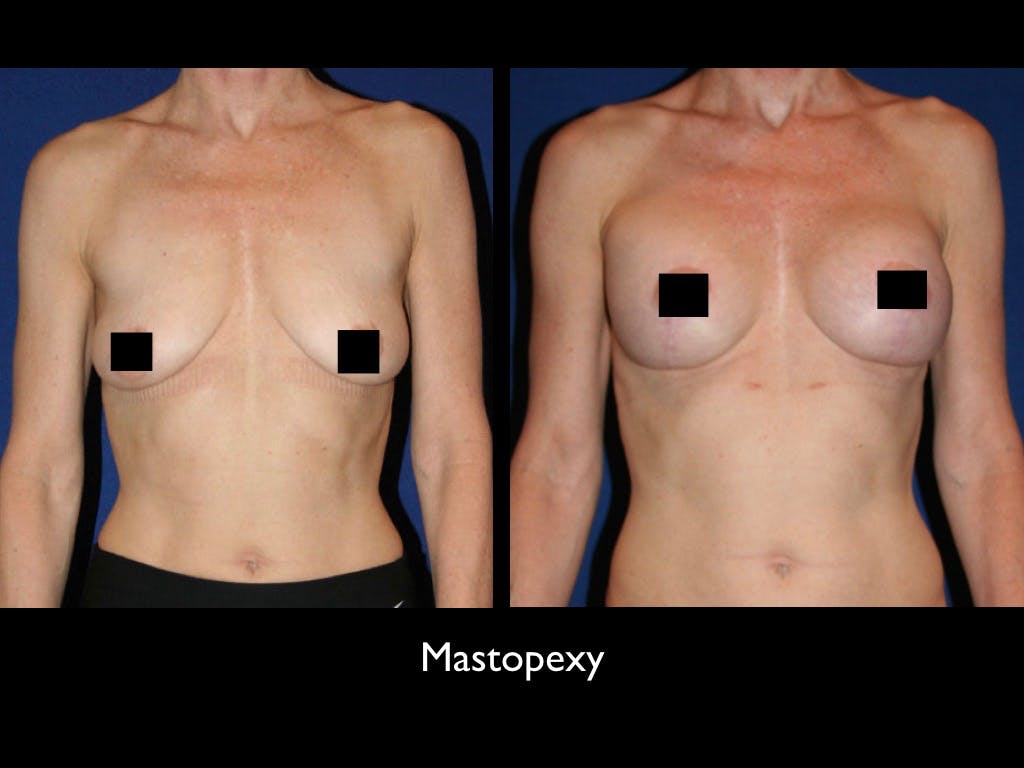Breast Lift Before & After Gallery - Patient 79205801 - Image 1