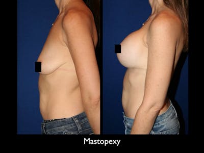 Breast Lift Before & After Gallery - Patient 79205802 - Image 1