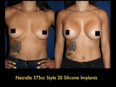 Breast Augmentation Before & After Gallery - Patient 79205626 - Image 1