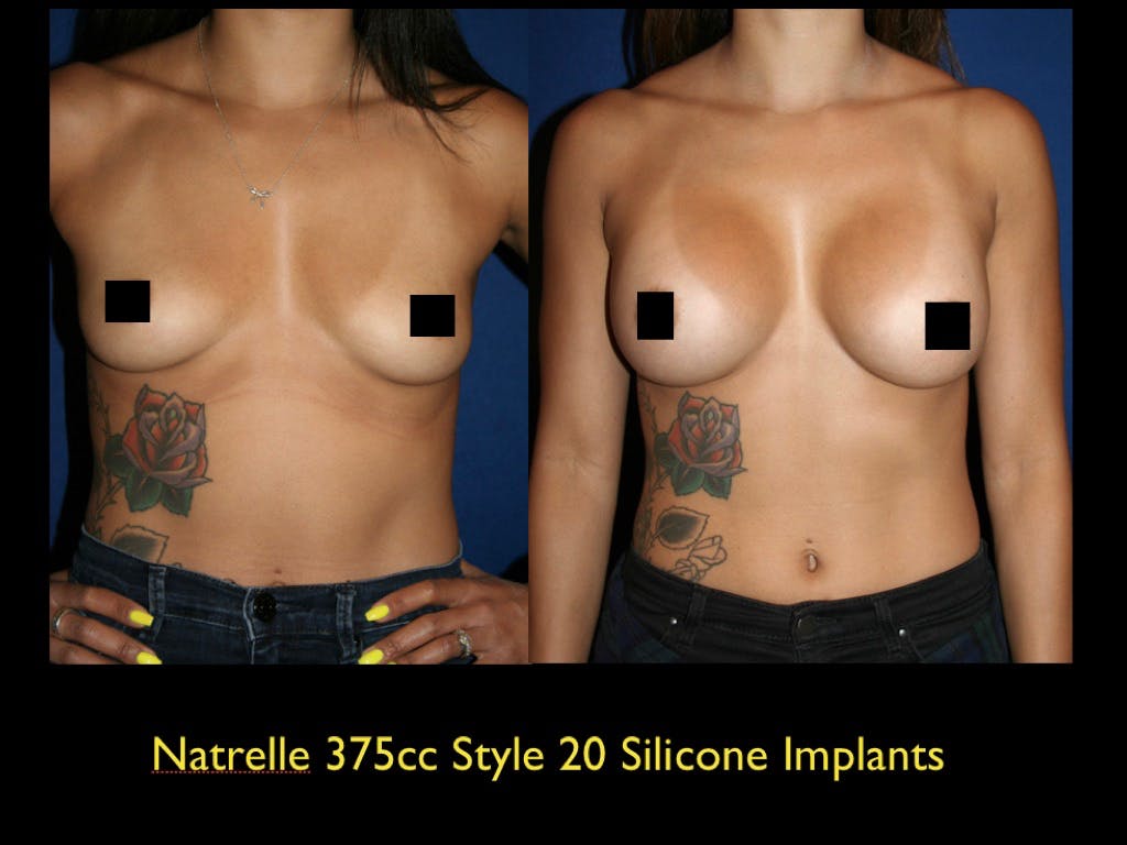 Breast Augmentation Before & After Gallery - Patient 79205626 - Image 1