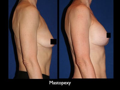 Breast Lift Before & After Gallery - Patient 79205804 - Image 1