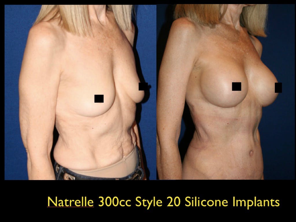 Breast Augmentation Before & After Gallery - Patient 79205628 - Image 1