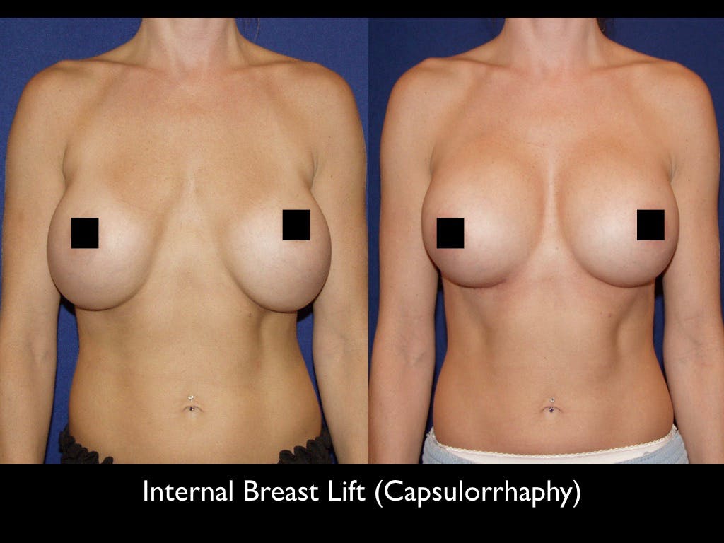 Breast Lift Before & After Gallery - Patient 79205806 - Image 1