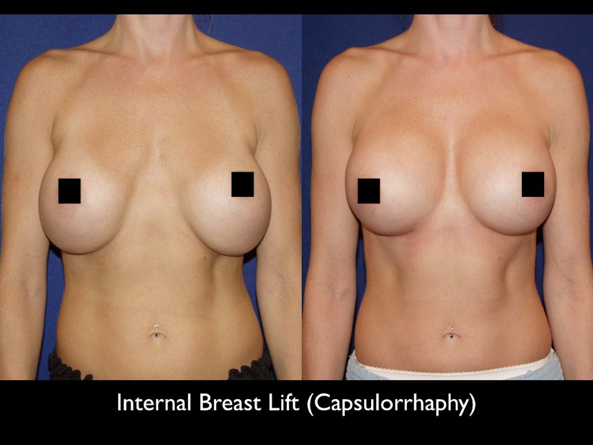 Breast Lift Before & After Gallery - Patient 79205806 - Image 1