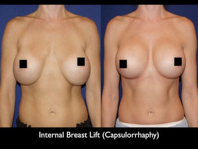 Breast Lift Before & After Gallery - Patient 79205806 - Image 1