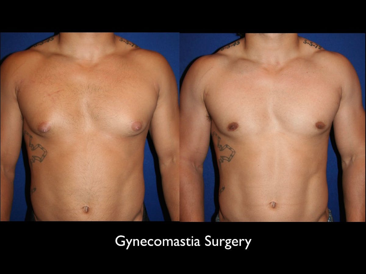Gynecomastia Before & After Gallery - Patient 68374221 - Image 2