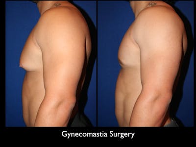 Gynecomastia Before & After Gallery - Patient 68374221 - Image 1