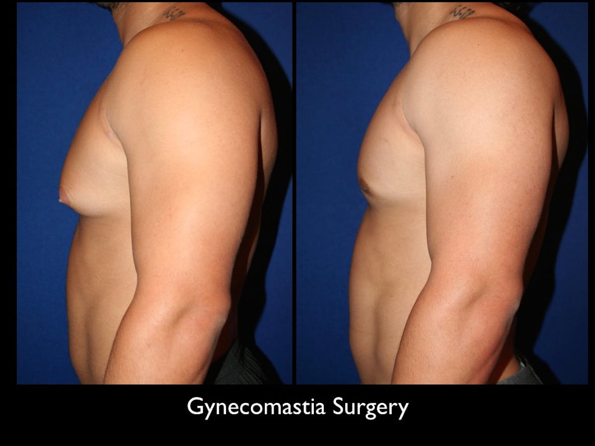 Gynecomastia Before & After Gallery - Patient 68374221 - Image 1