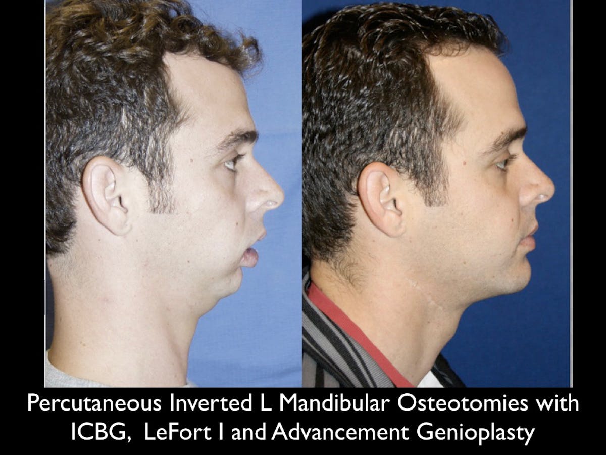 Chin Augmentation Before & After Gallery - Patient 79206056 - Image 1