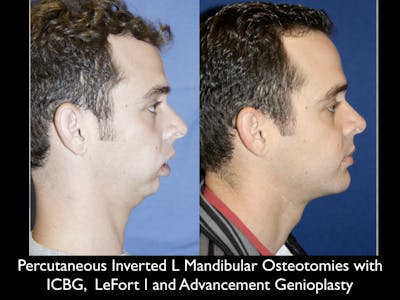Chin Augmentation Before & After Gallery - Patient 79206056 - Image 1