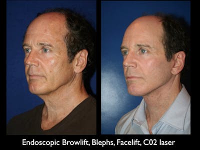 Facelift Before & After Gallery - Patient 79206510 - Image 1