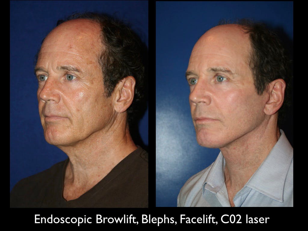 Facelift Before & After Gallery - Patient 79206510 - Image 1