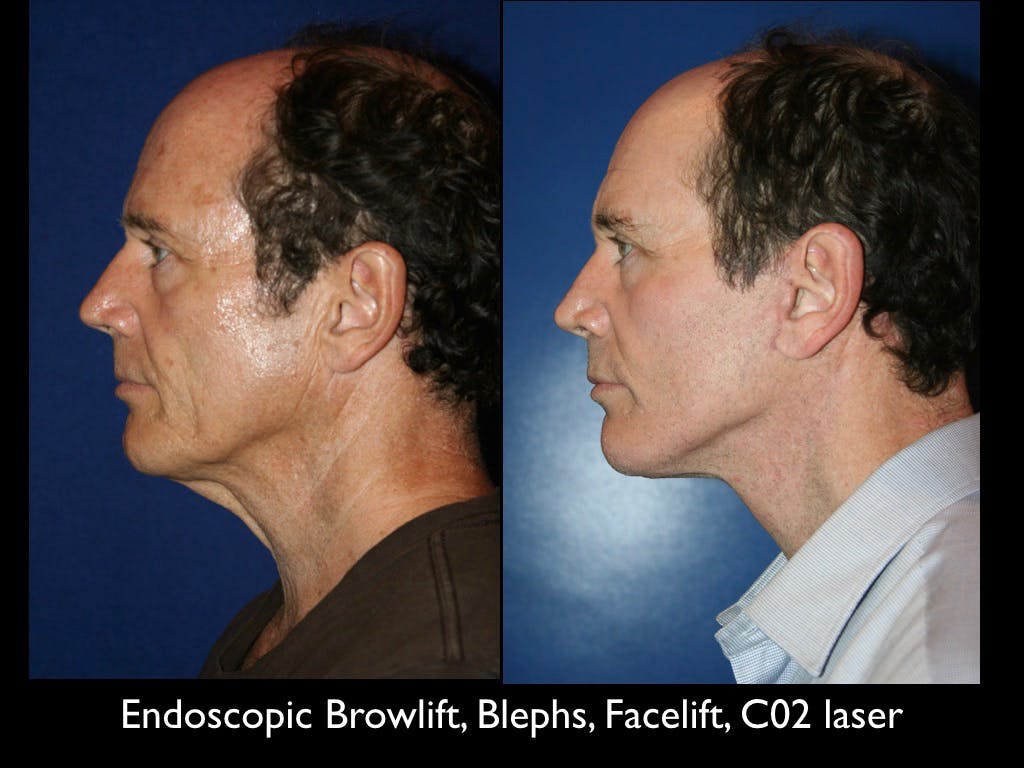Facelift Before & After Gallery - Patient 79206510 - Image 2