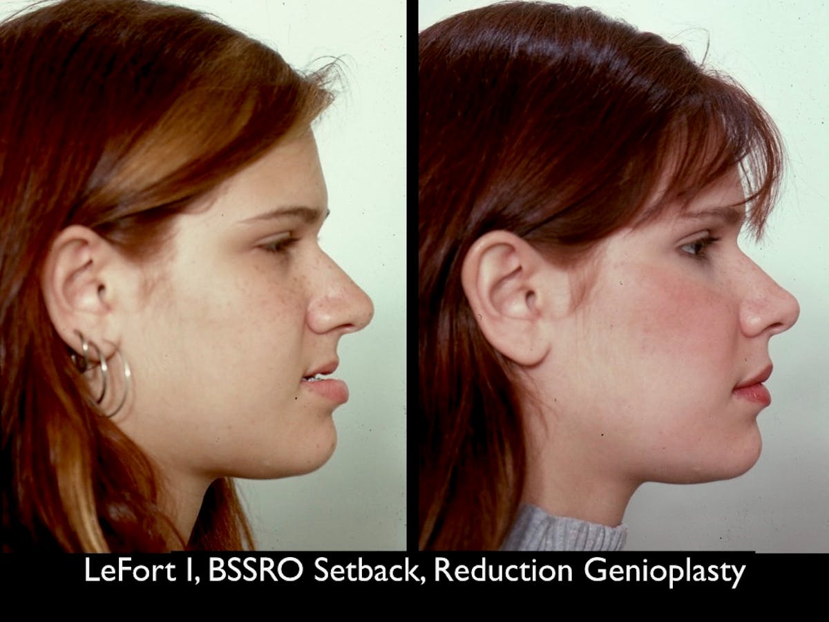 Chin Augmentation Before & After Gallery - Patient 79206058 - Image 1