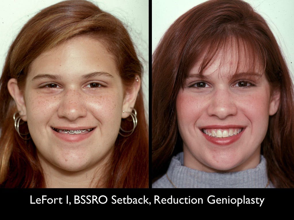 Chin Augmentation Before & After Gallery - Patient 79206058 - Image 2