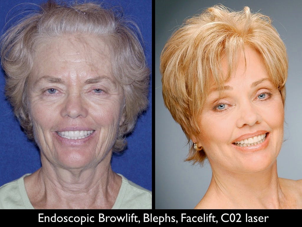 Facelift Before & After Gallery - Patient 79206512 - Image 1