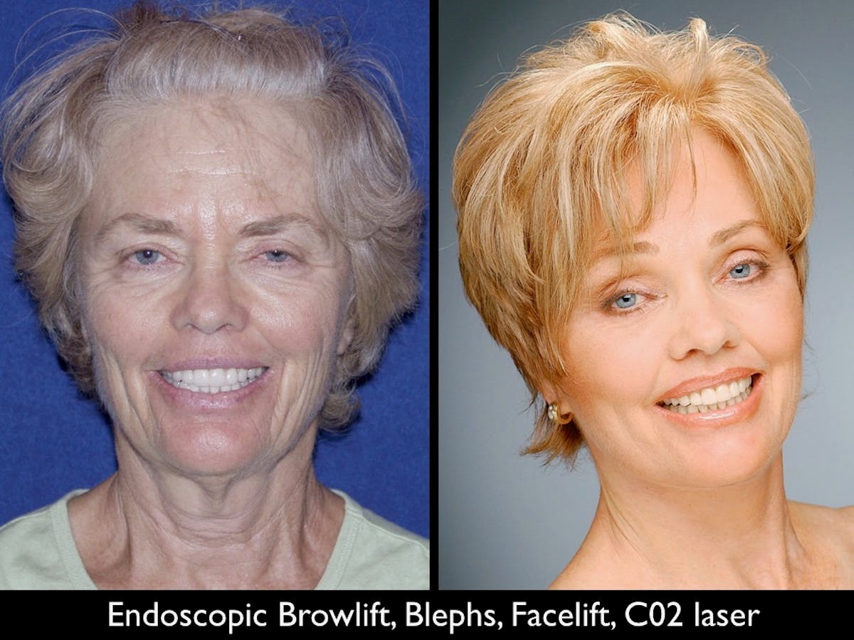 Brow Lift Before & After Gallery - Patient 79206170 - Image 1