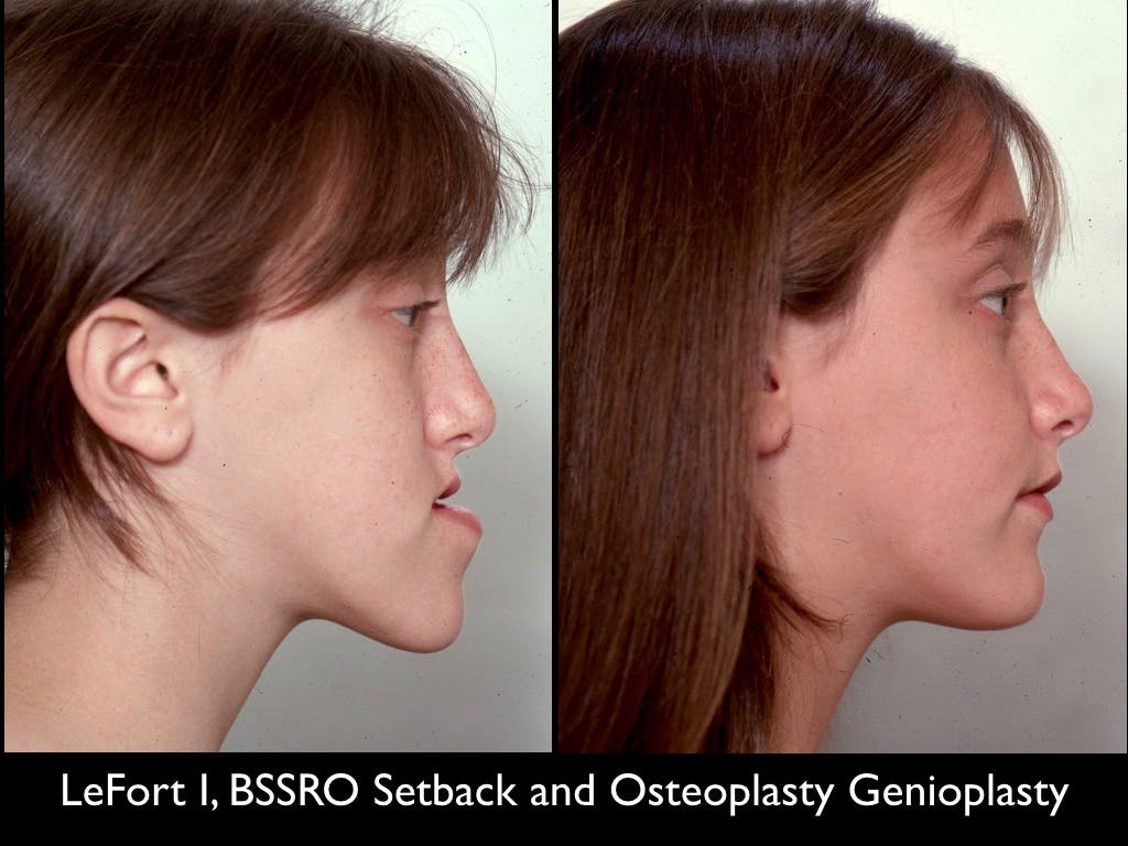 Chin Augmentation Before & After Gallery - Patient 79206060 - Image 1