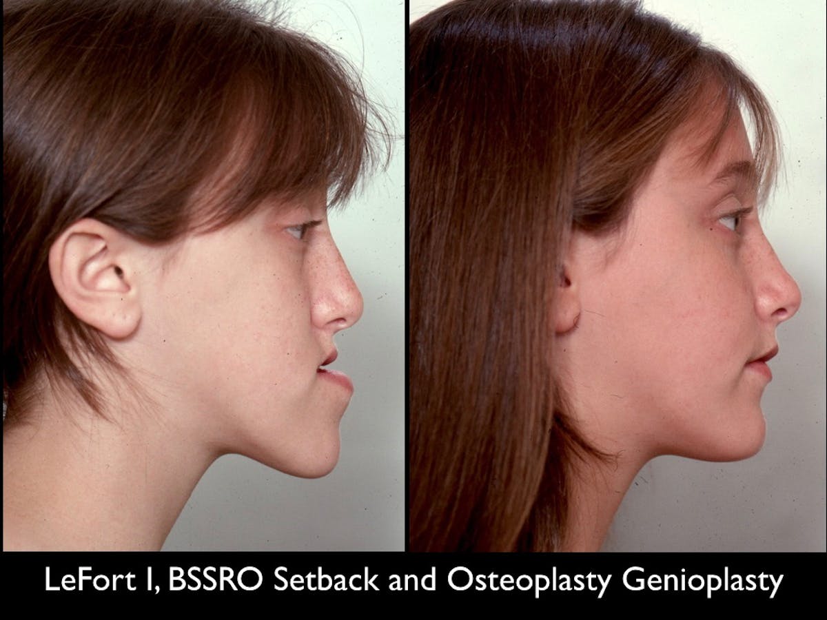 Chin Augmentation Before & After Gallery - Patient 79206060 - Image 1
