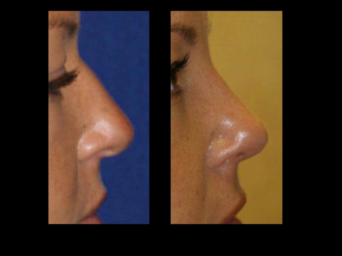 Rhinoplasty Before & After Gallery - Patient 79206555 - Image 1