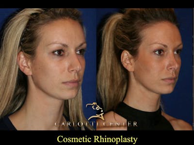 Rhinoplasty Before & After Gallery - Patient 79206557 - Image 1