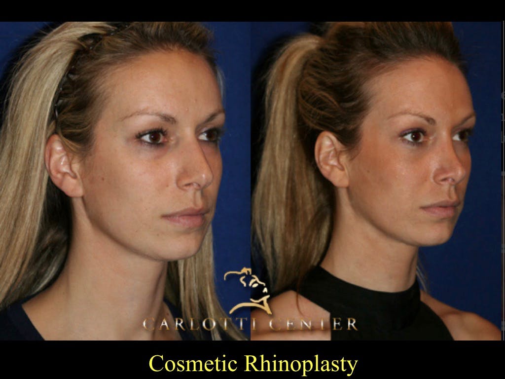 Rhinoplasty Before & After Gallery - Patient 79206557 - Image 1