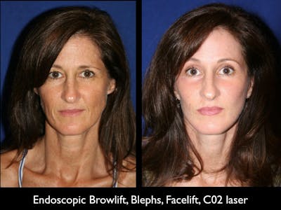 Brow Lift Before & After Gallery - Patient 79206176 - Image 1