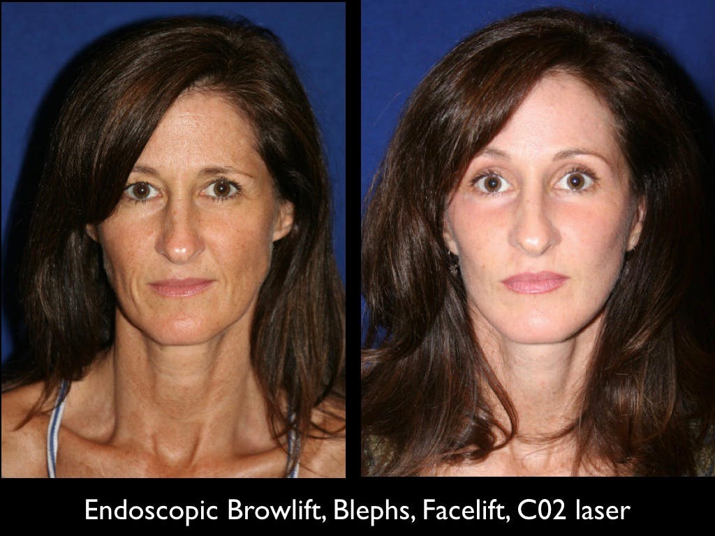 Facelift Before & After Gallery - Patient 79206518 - Image 1
